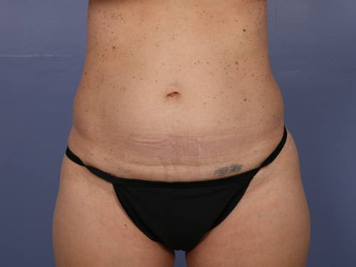 Tummy Tuck before and after photo