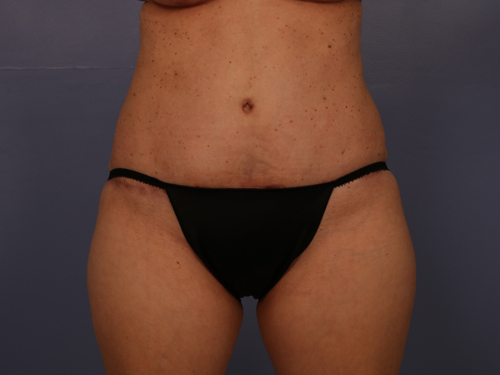 Tummy Tuck before and after photo