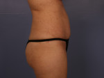 Tummy Tuck Before and after photo