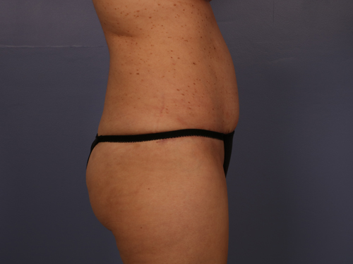 Tummy Tuck before and after photo