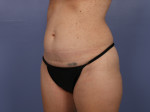 Tummy Tuck Before and after photo