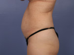 Tummy Tuck Before and after photo