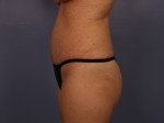 Tummy Tuck Before and after photo