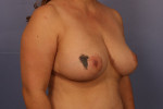 Breast Reduction (for Women) Before and after photo