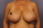 Breast Reduction (for Women) Before and after photo