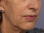 Injectable Fillers Before and after photo