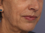 Injectable Fillers Before and after photo