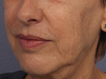 Injectable Fillers Before and after photo