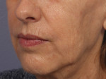 Injectable Fillers Before and after photo