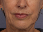 Injectable Fillers Before and after photo