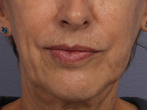 Injectable Fillers before and after photo