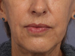 Injectable Fillers Before and after photo