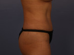 Liposuction Before and after photo