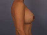 Liposuction Before and after photo