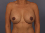 Liposuction Before and after photo