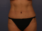 Liposuction Before and after photo