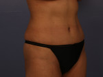 Liposuction Before and after photo