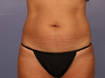 Liposuction Before and after photo