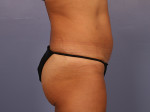 Liposuction Before and after photo