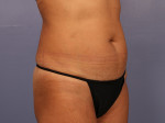 Liposuction Before and after photo