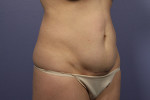 Tummy Tuck Before and after photo