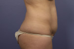 Tummy Tuck Before and after photo