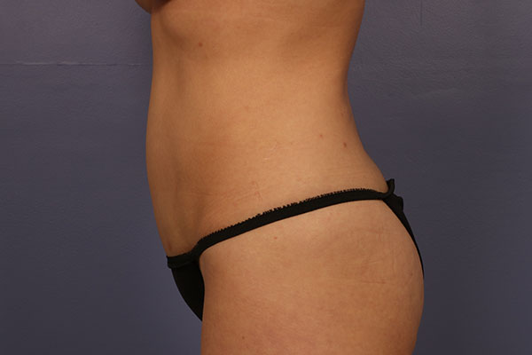 Tummy Tuck before and after photo