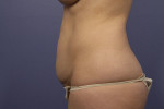 Tummy Tuck Before and after photo