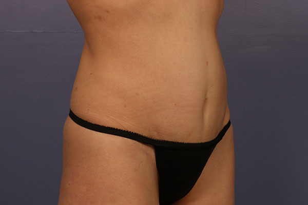 Tummy Tuck before and after photo