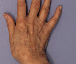 Laser Skin Resurfacing
