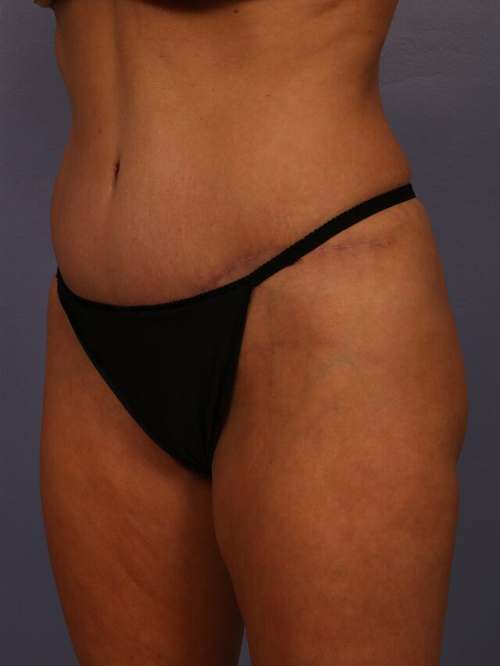 Tummy Tuck before and after photo