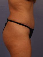 Tummy Tuck Before and after photo