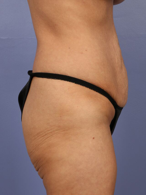 Tummy Tuck before and after photo