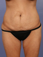 Tummy Tuck Before and after photo