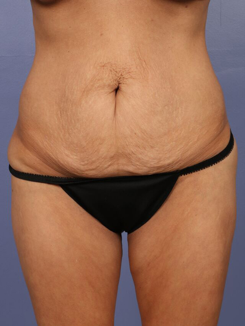 Tummy Tuck before and after photo