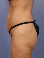 Tummy Tuck Before and after photo