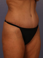 Tummy Tuck Before and after photo