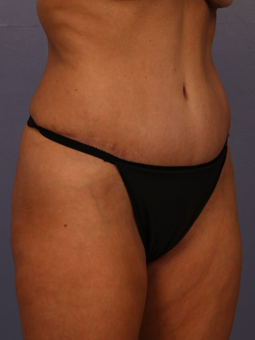 Tummy Tuck before and after photo