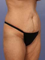 Tummy Tuck Before and after photo