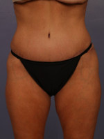 Tummy Tuck Before and after photo