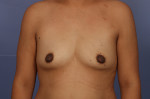 Breast Augmentation Before and after photo