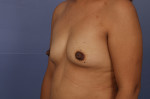 Breast Augmentation Before and after photo