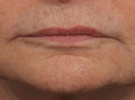 Injectable Fillers Before and after photo