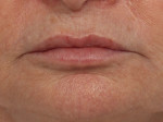 Injectable Fillers Before and after photo