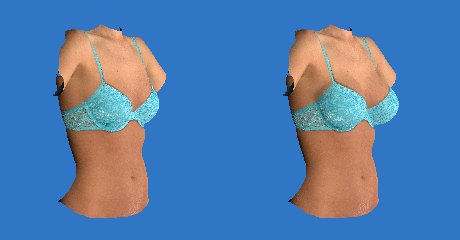 VECTRA breast imagery
